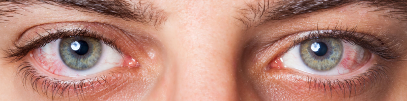 Why are my eyes red bloodshot?